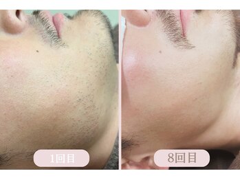 エピル(EPIL)/脱毛