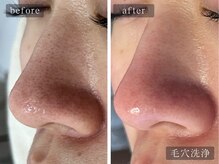 アムールサロン(Amour salon)/ハイドラ/毛穴洗浄/新宿/美肌