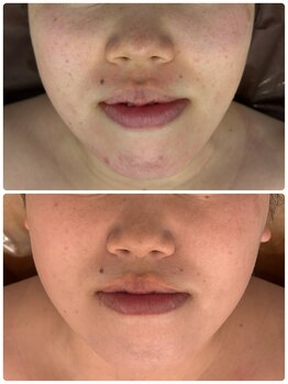 アール(R)/6か月の変化 ビフォーアフター