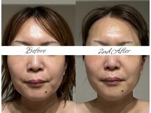 マヌレニ(manuleni)/引き締め&むくみも取れて別人級