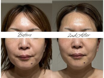 マヌレニ(manuleni)/引き締め&むくみも取れて別人級