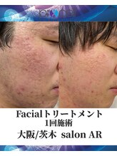 メンズサロンアール(AR)/プロセルセラピーズフェイシャル