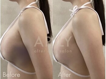 アリリィ(ARILY)/インディバダウンタイム/表参道