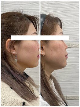 長寿鍼灸院 長寿整骨院/美容鍼50本の効果★小顔効果