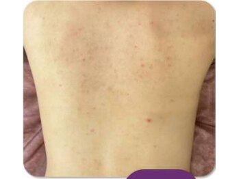 お顔そりローズマリー/ボディハーブピーリング