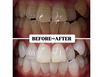 ホワイトニングサロン 豊中/Before&After美白ホワイトニング
