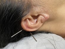 ジェネ鍼灸院/花粉のお悩みも対応！