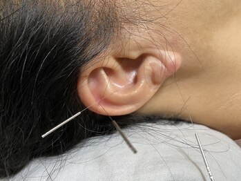 ジェネ鍼灸院/花粉のお悩みも対応！