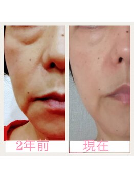 マックス(MAX)/幹細胞フェイシャル&ホームケア