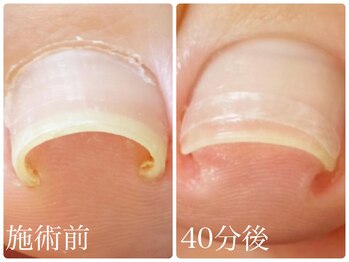 巻き爪改善ケア