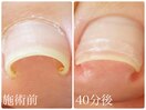 巻き爪改善ケア