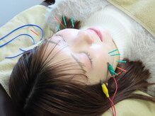 セレナ整骨院 池袋院/美容鍼