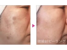 フルールの雰囲気（マイクロニ-ドルピ-リング塗る針刺激でシミ・しわケア年齢肌改善）