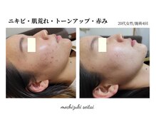 望月整体院/ニキビ・肌荒れ