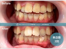 セルフホワイトニング専門店 シマエナ上新庄駅前店/明るい笑顔の口元へ