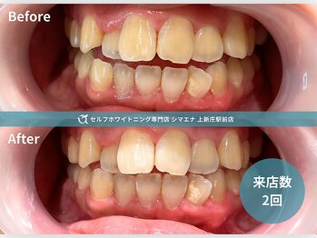 セルフホワイトニング専門店 シマエナ上新庄駅前店/明るい笑顔の口元へ