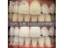 シカホワイトニングトウキョウ 笹塚店(CICA Whitening Tokyo)の雰囲気(30代女性 ビフォーアフター)