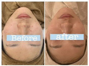 モイ(moi.)/◆マイクロニードルピーリング◆