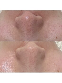 ハーナウ ハウ(hanau hou)/毛穴洗浄