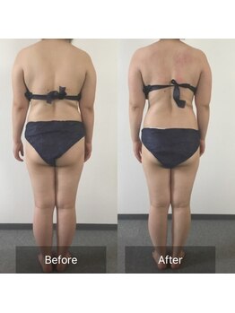 ボディメイクサロンアプローズ/背中スッキリ