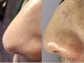 キャンディ 大阪梅田店(CANDi)/ハイドラピーリング/黒ずみ毛穴