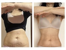 ボディアーキ 高知大丸店(BODY ARCHI)/お腹のbefore・after