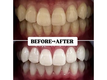 ホワイトニングサロン 豊中/Before&After美白ホワイトニング