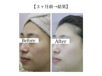 スマートポッシュ(Smart posh)/【シミケア】before→after