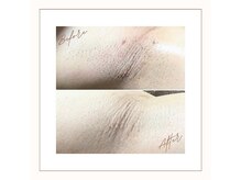 ラベニール(La Benir)/わき脱毛