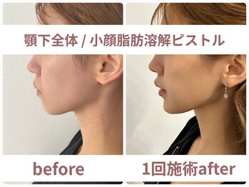 サボラミ(sabor A Mi)/顎下小顔溶解ピストル 1回施術