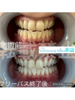 ホワイトニングサロン 名古屋 栄店/【ホワイトニング】