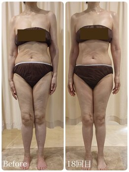 ルノン(Lunon)/《全身歪み》歪み改善＝快調