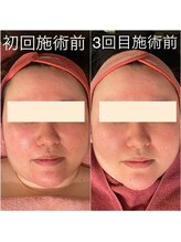 ルミラポー(Lumira Peau)/シミ集中ケア＋肌質改善