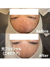 ブルームーン(BLUE MOON)/光フェイシャル(ニキビケア)