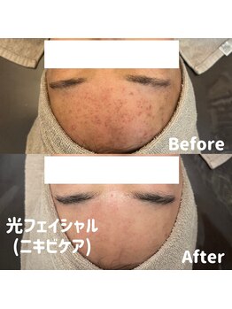 ブルームーン(BLUE MOON)/光フェイシャル(ニキビケア)