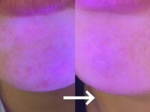 エクラ(eclat)/アクネ菌殺菌/プラズマシャワー