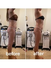 美肌工房ルノン(Lunon)/ダイエット：before／after