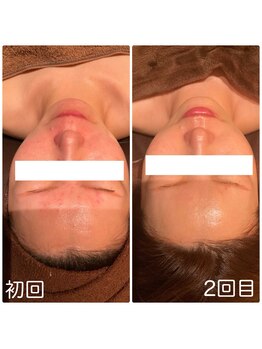 チェンジ(Change)/急な赤みもたった2回で◎