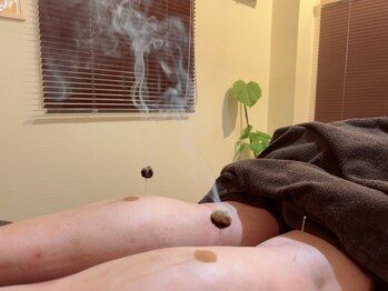 鍼灸ハウス(鍼灸house)/灸頭鍼