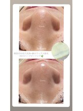 クレヴィー(Creviy)/韓国式3D毛穴洗浄＋ハーブ＋脱毛