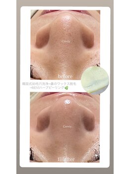 クレヴィー(Creviy)/韓国式3D毛穴洗浄+ハーブ+脱毛
