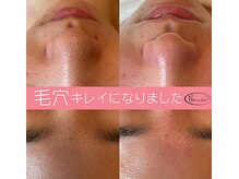 フルリール(Fleurir)/毛穴エクストラクションtete式