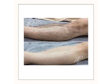 ラベニール(La Benir)/やりがいだらけの手足脱毛