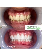 ホワイトニングサロン 名古屋駅店/【ホワイトニング施術例】