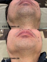 ライズ(Rise+)/髭脱毛３回目