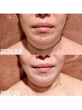 ラ シャルール 元町/美容外科入らずの整顔リフトケア