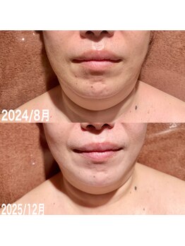 ラ シャルール 元町/美容外科入らずの整顔リフトケア