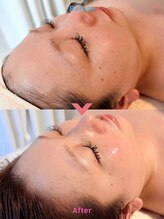 エテル(eter)/セラピール1回目