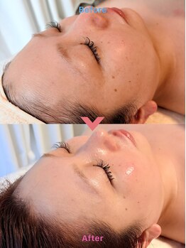 エテル(eter)/セラピール1回目