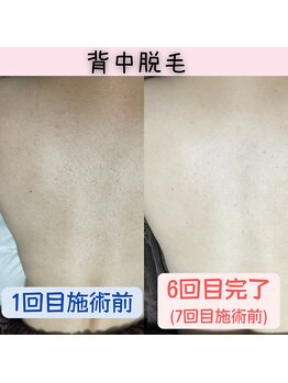 サロン ミナミ(SALON MINAMI)/背中ビフォー・アフター